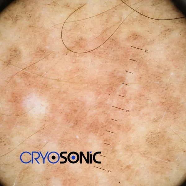 Speak to our team today about sun damaged skin treatment today in West-Bromwich