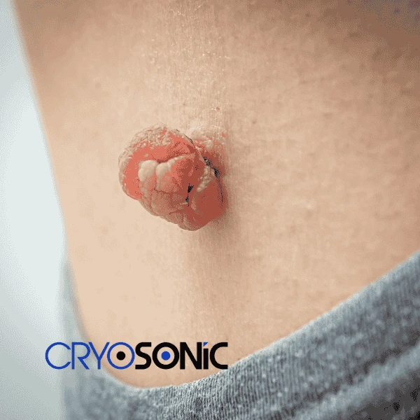Book your skin tags removal West-Bromwich from comfort of your own home! West-Bromwich