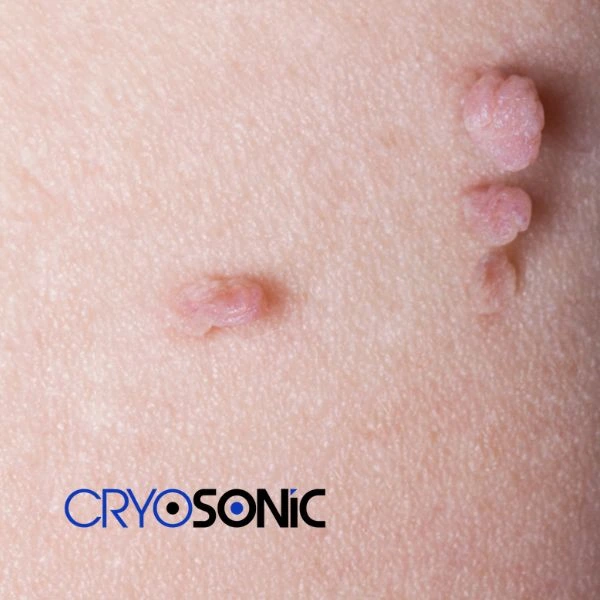 Are you looking for fast effect skin tag removal West-Bromwich? Book in NOW! West-Bromwich