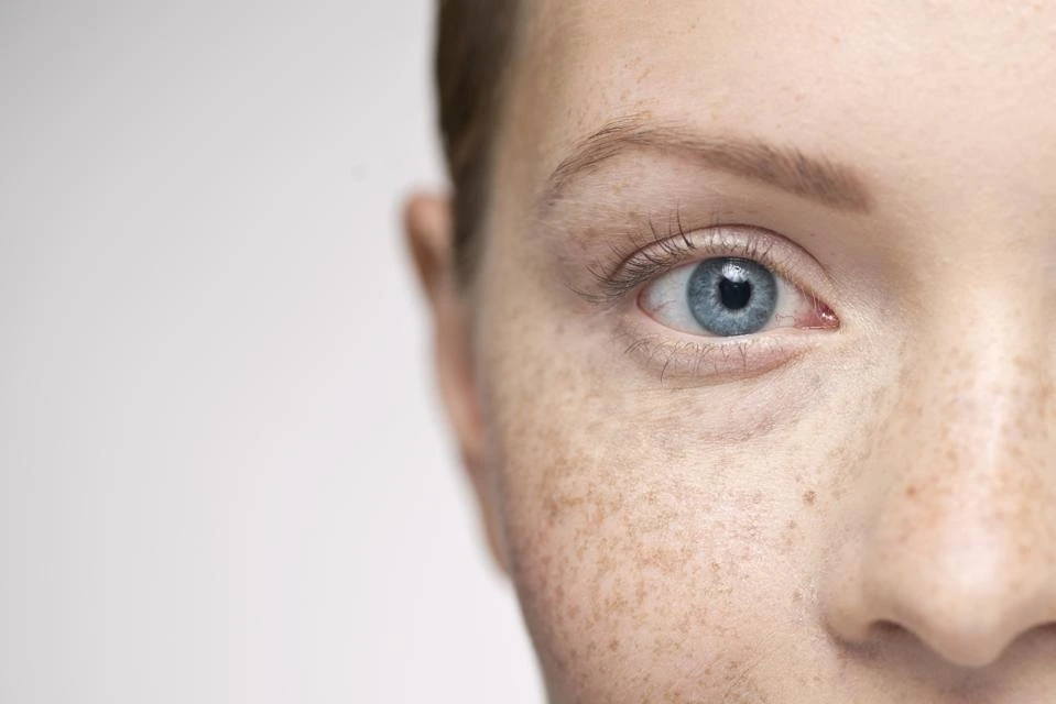 Understanding Sun Damage: How UV Rays Alter Skin and How CryoPen Can Reverse It West-Bromwich
