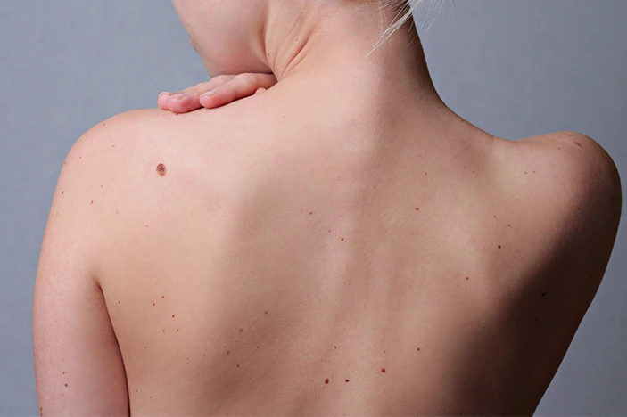 The Skin’s Healing Journey After CryoPen Sun Damage Treatment West-Bromwich