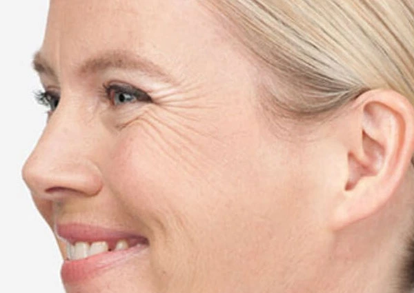 CryoPen Precision vs. Laser: Which Is Better for Sun-Damaged Skin? West-Bromwich