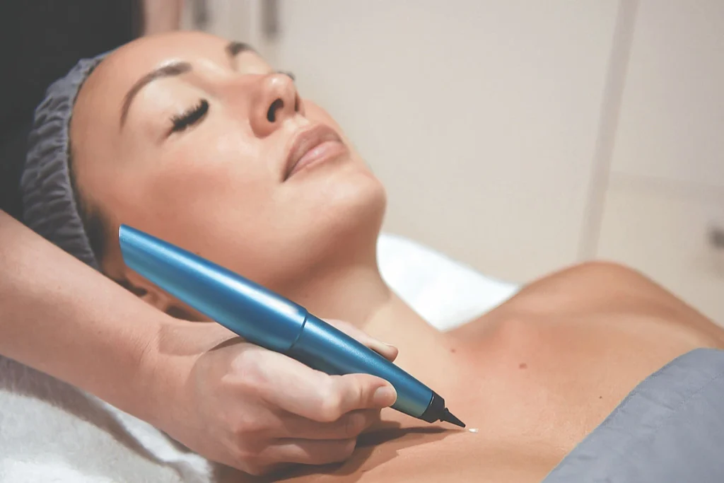 What is CryoPen Technology West-Bromwich? West-Bromwich