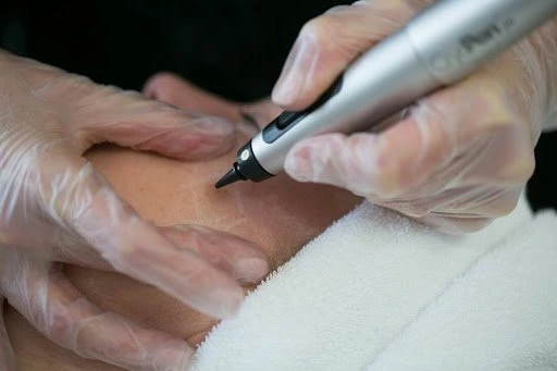 The CryoPen Technology Explained: How Extreme Cold Removes Sun-Damaged Skin Cells West-Bromwich