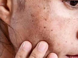 Why CryoPen Works Best for Isolated Sun Spots and Pigmentation West-Bromwich