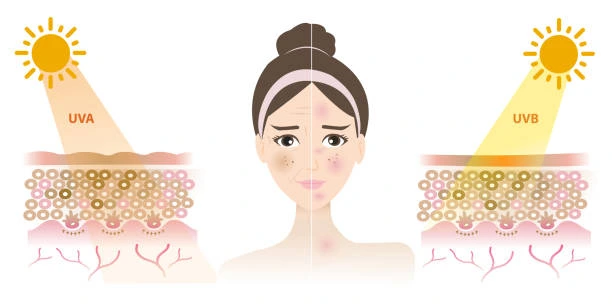 Understanding Sun Damage West-Bromwich : How Do UV Rays Cause Changes in the Skin? West-Bromwich