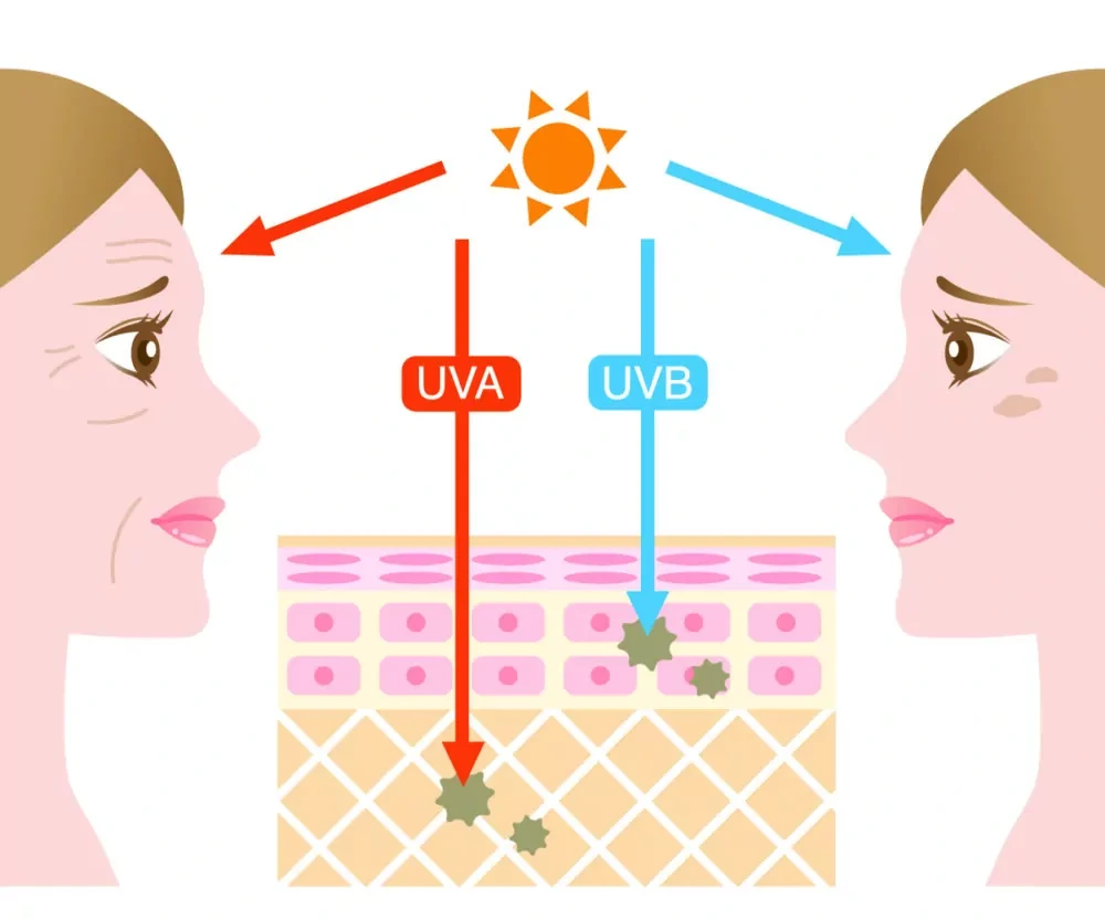 Understanding Sun Damage West-Bromwich - Why Should Sun Damage Be Treated Early? West-Bromwich